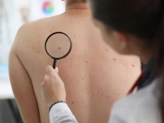 Avance contra el melanoma: una vacuna experimental logró resultados positivos en un ensayo clave